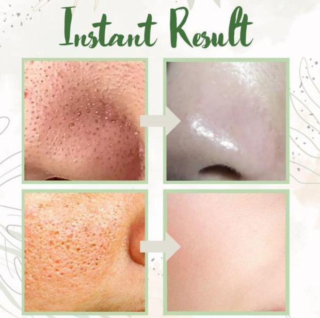 Anti Acne Clay Mask