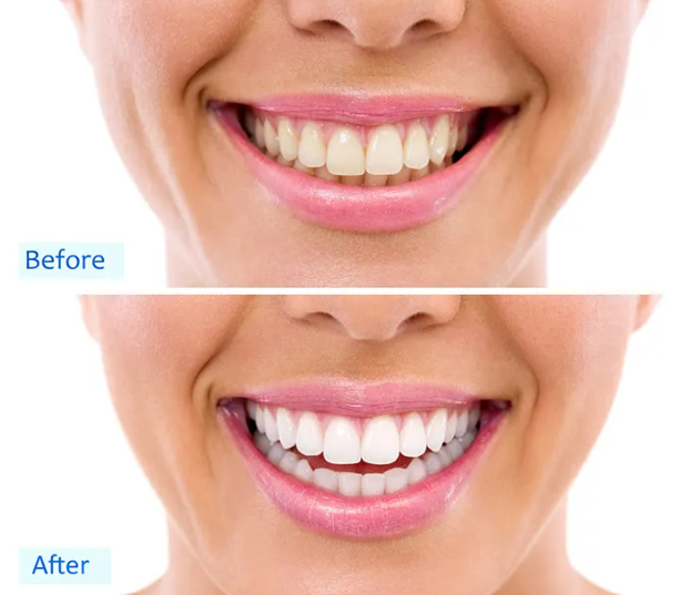 Teeth Whitening Toothpaste